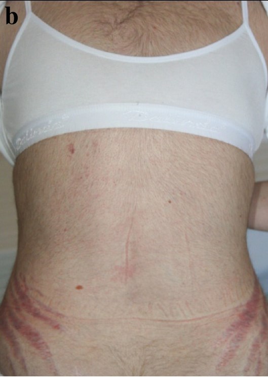 Cushing's Syndrome Body Habitus SimpleMed