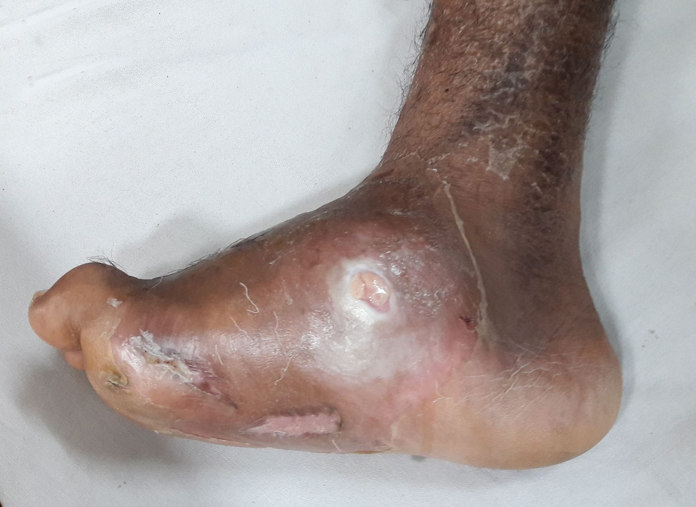 Charcot Foot Deformity SimpleMed