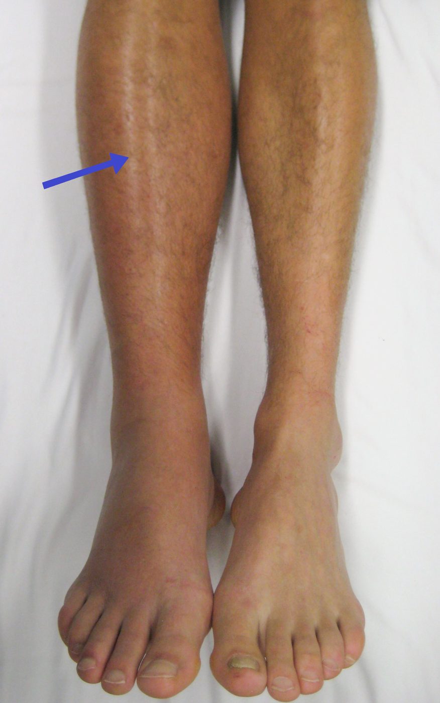 Deep Vein Thrombosis Swollen Right Leg SimpleMed