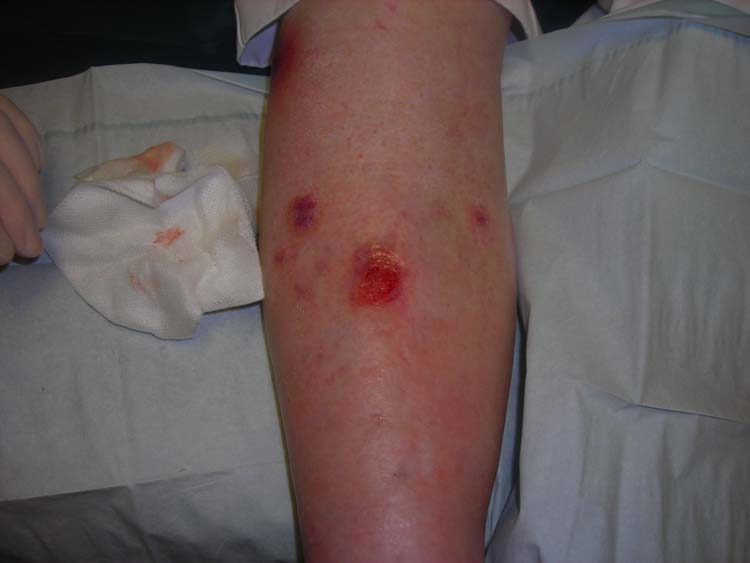 Venous Leg Ulcer SimpleMed