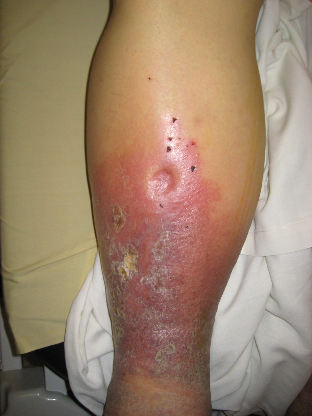 Pitting Oedema of the Lower Leg SimpleMed