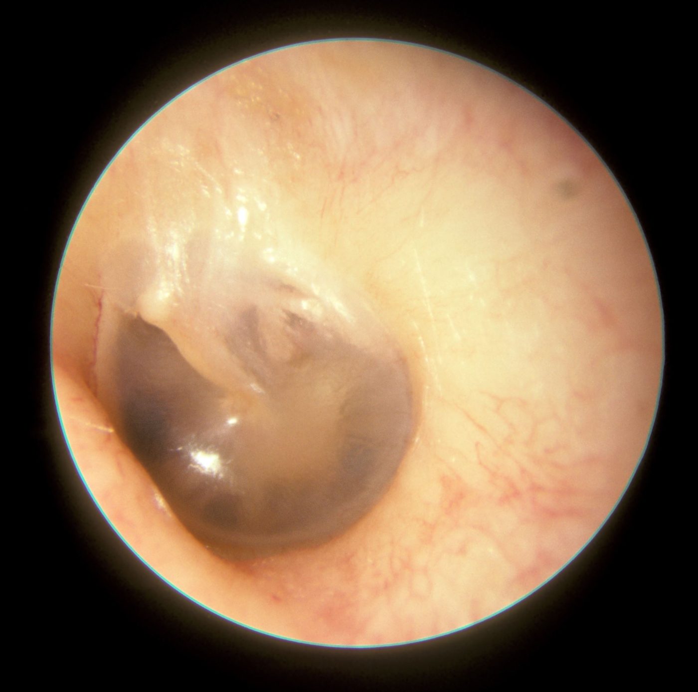 Normal Tympanic Membrane SimpleMed
