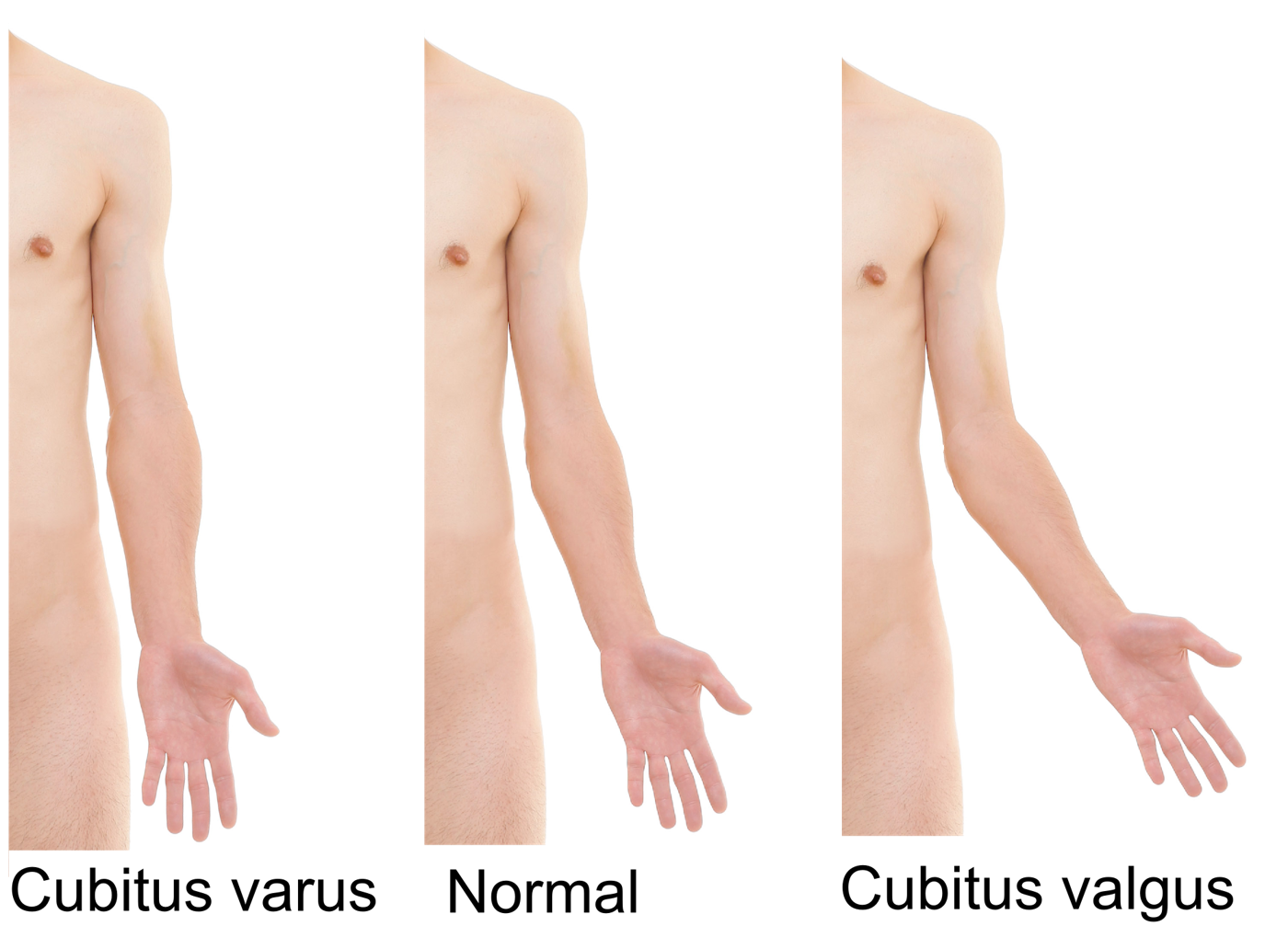 Cubitus Varus and Cubitus Valgus SimpleMed