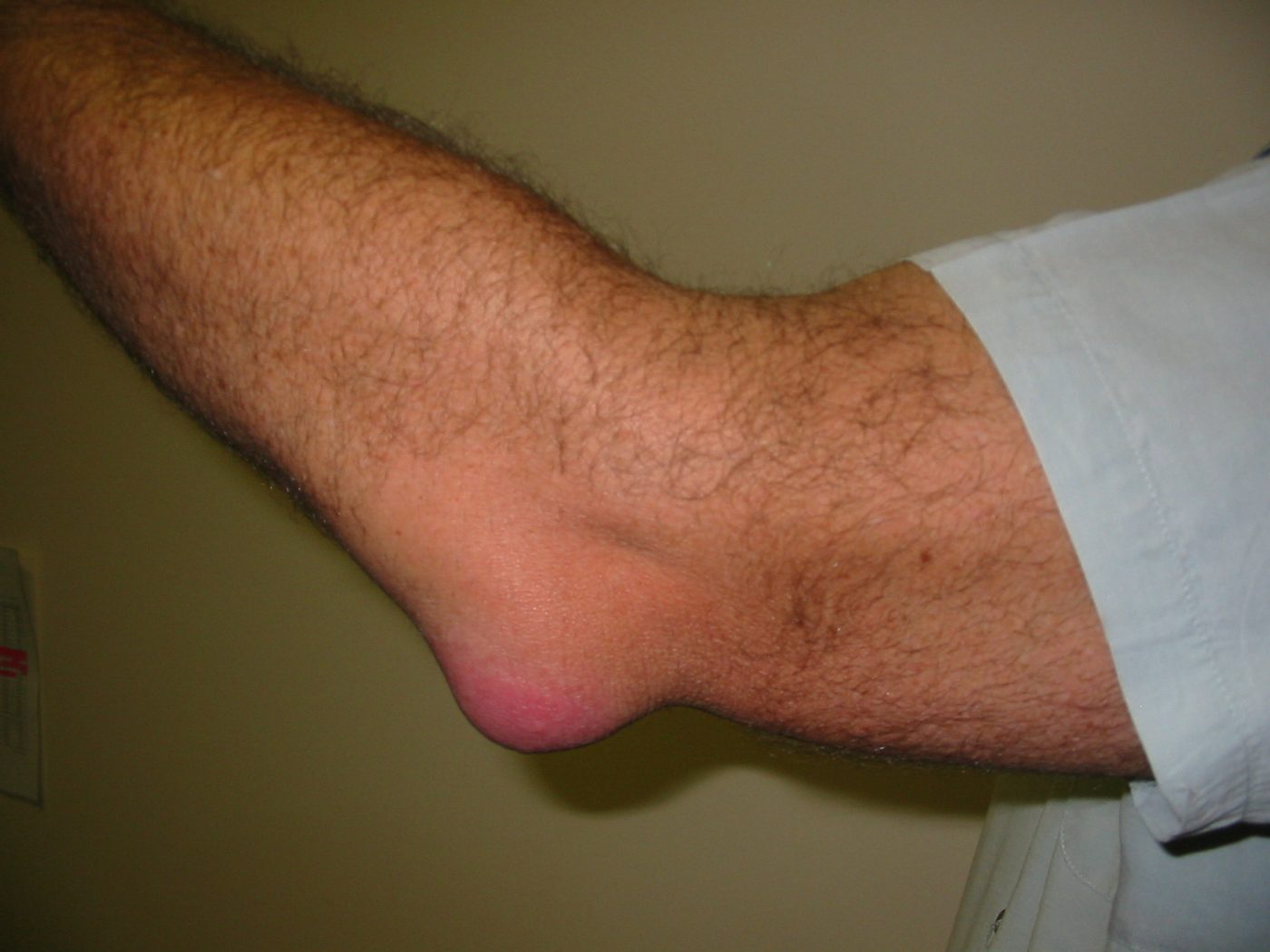Olecranon Bursitis SimpleMed