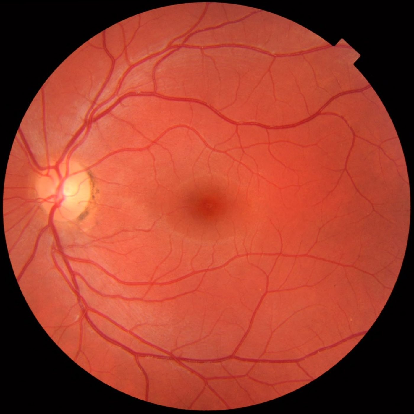 Normal Fundus SimpleMed
