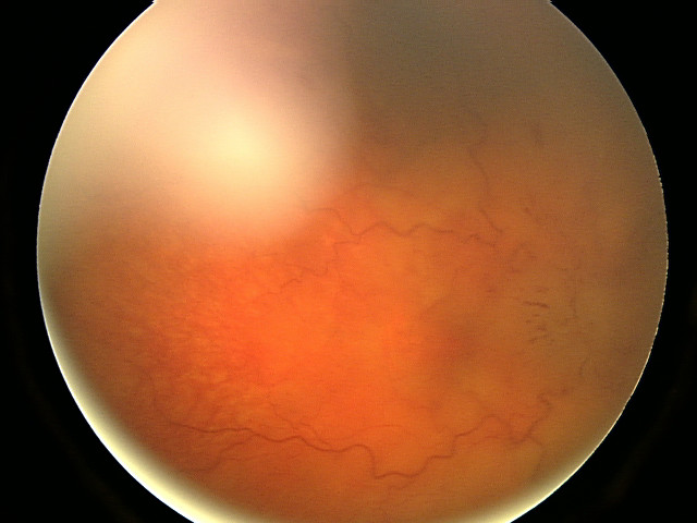 Papilloedema SimpleMed