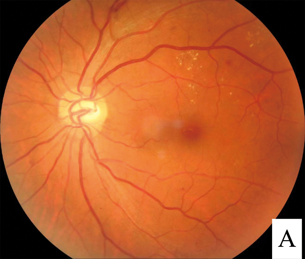 Diabetic Retinopathy Fundus SimpleMed