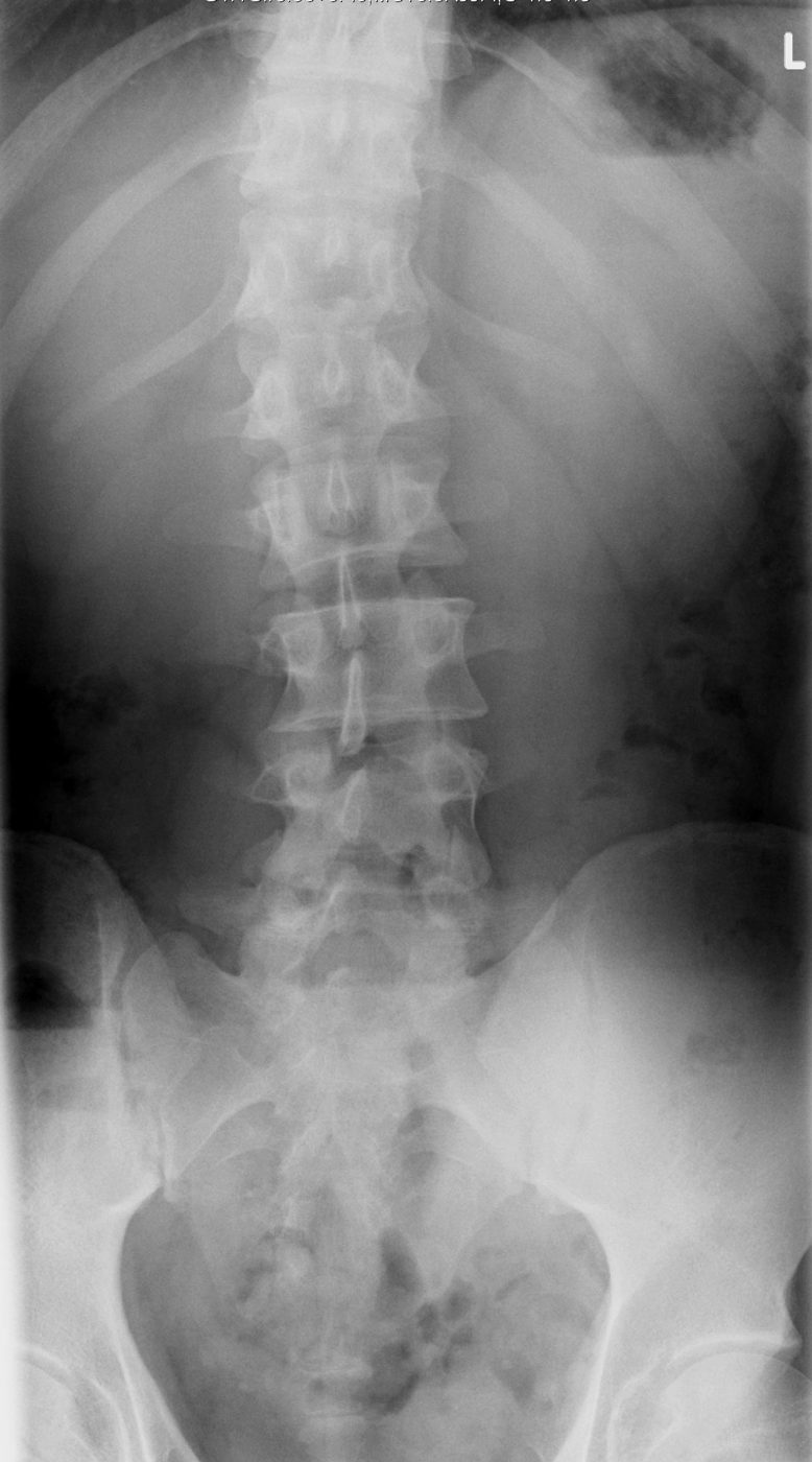 Scoliosis of the spine viewed from behind SimpleMed