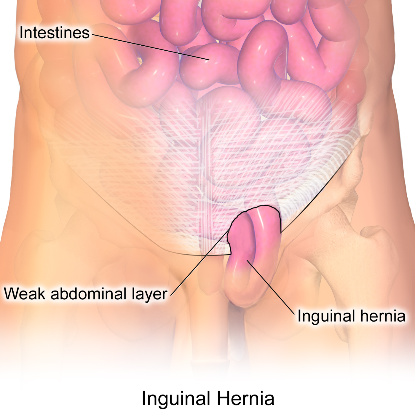 Inguinal hernia SimpleMed