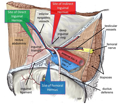 Sites of lower abdominal hernias SimpleMed
