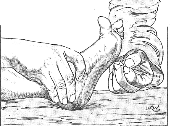 Babinski sign plantar reflex SimpleMed