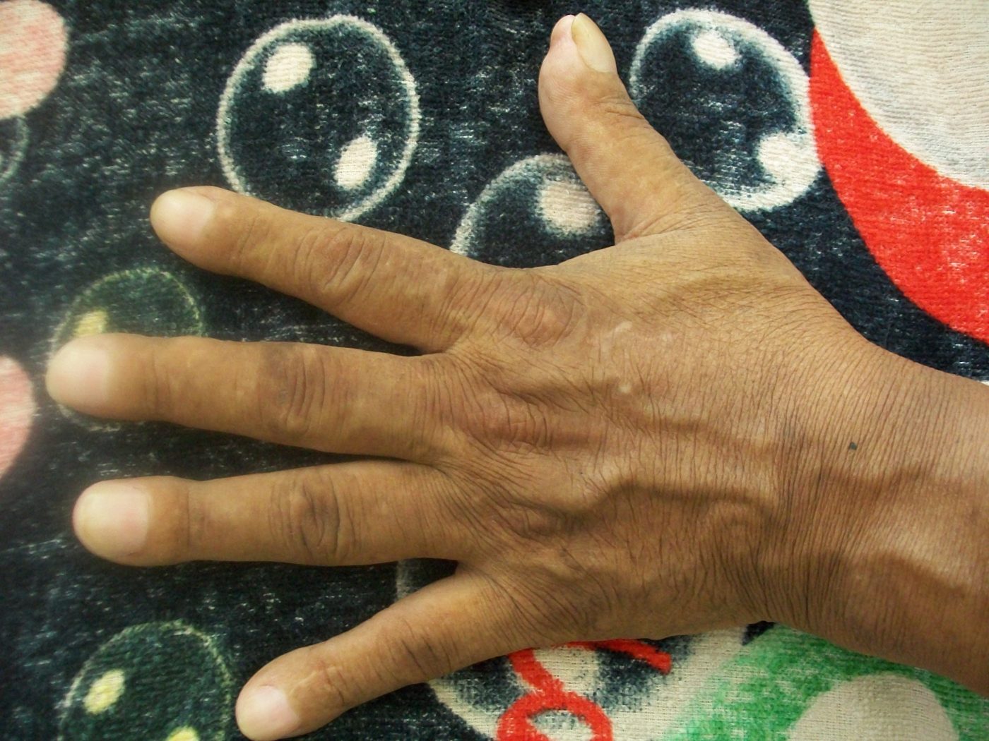 Finger Clubbing SimpleMed