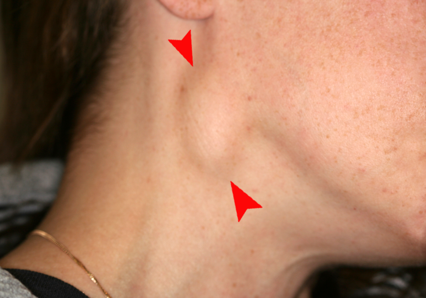 Cervical Lymphadenopathy SimpleMed