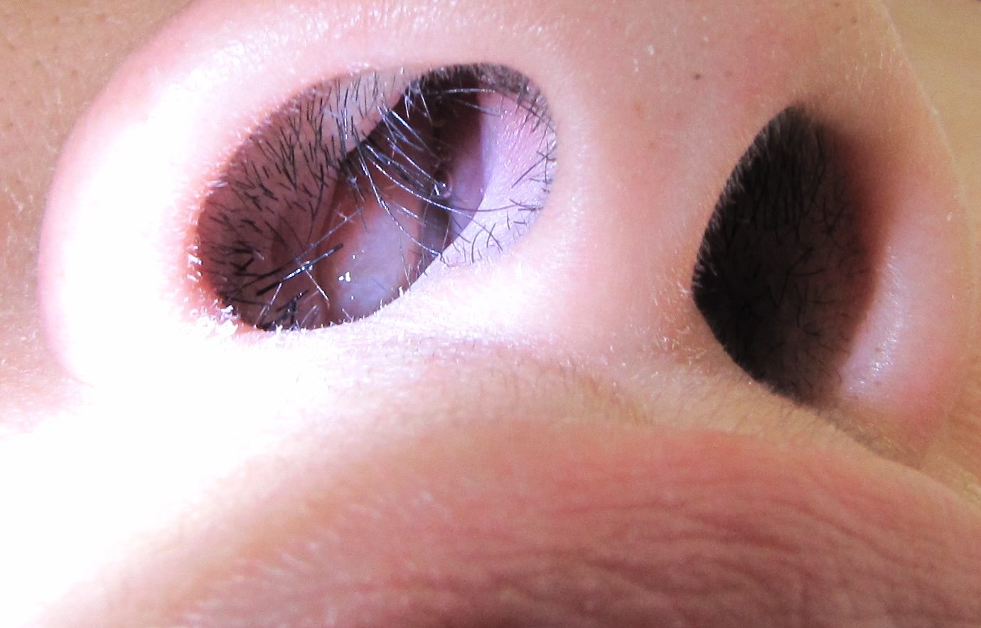 Nasal polyp SimpleMed