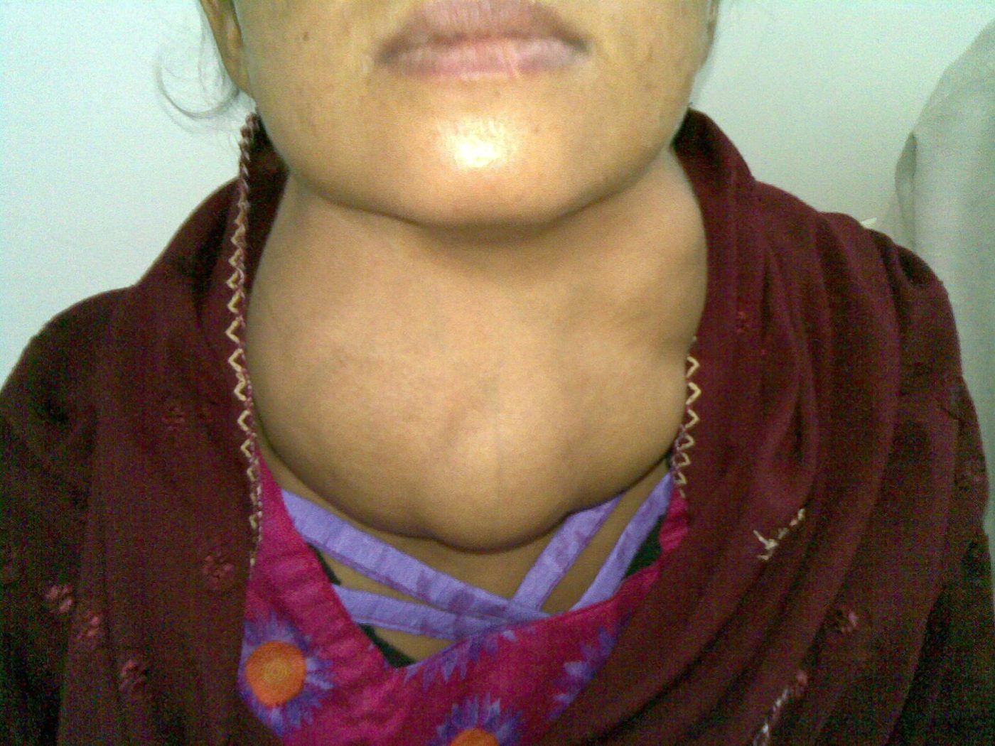 Goitre causing a midline swelling of the neck