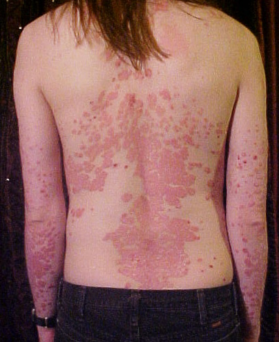 Plaque psoriasis on the back