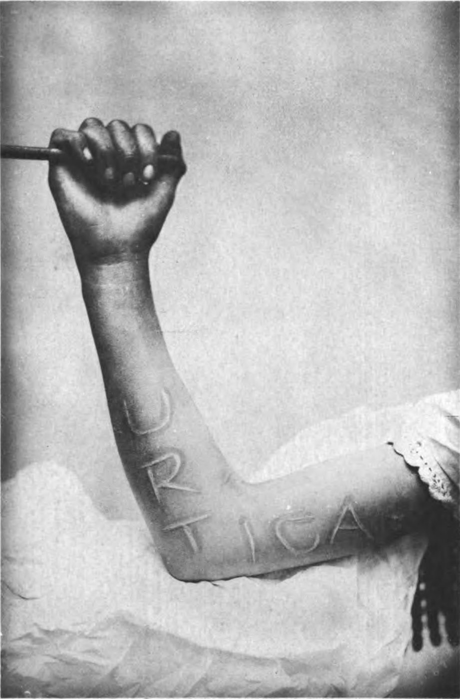 Urticarial wheals on the skin