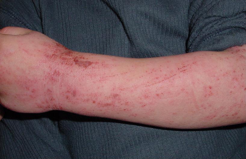 Atopic dermatitis in the flexure of a child's arm