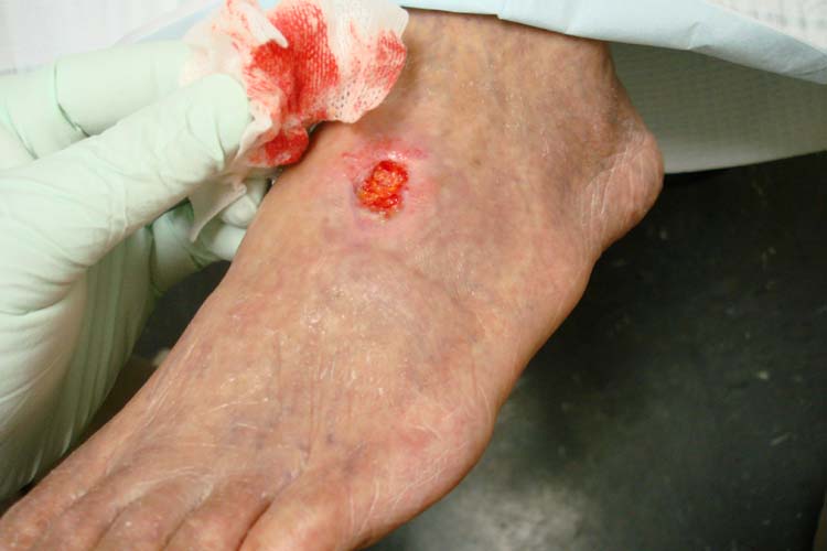 Arterial ulcer in peripheral vascular disease SimpleMed