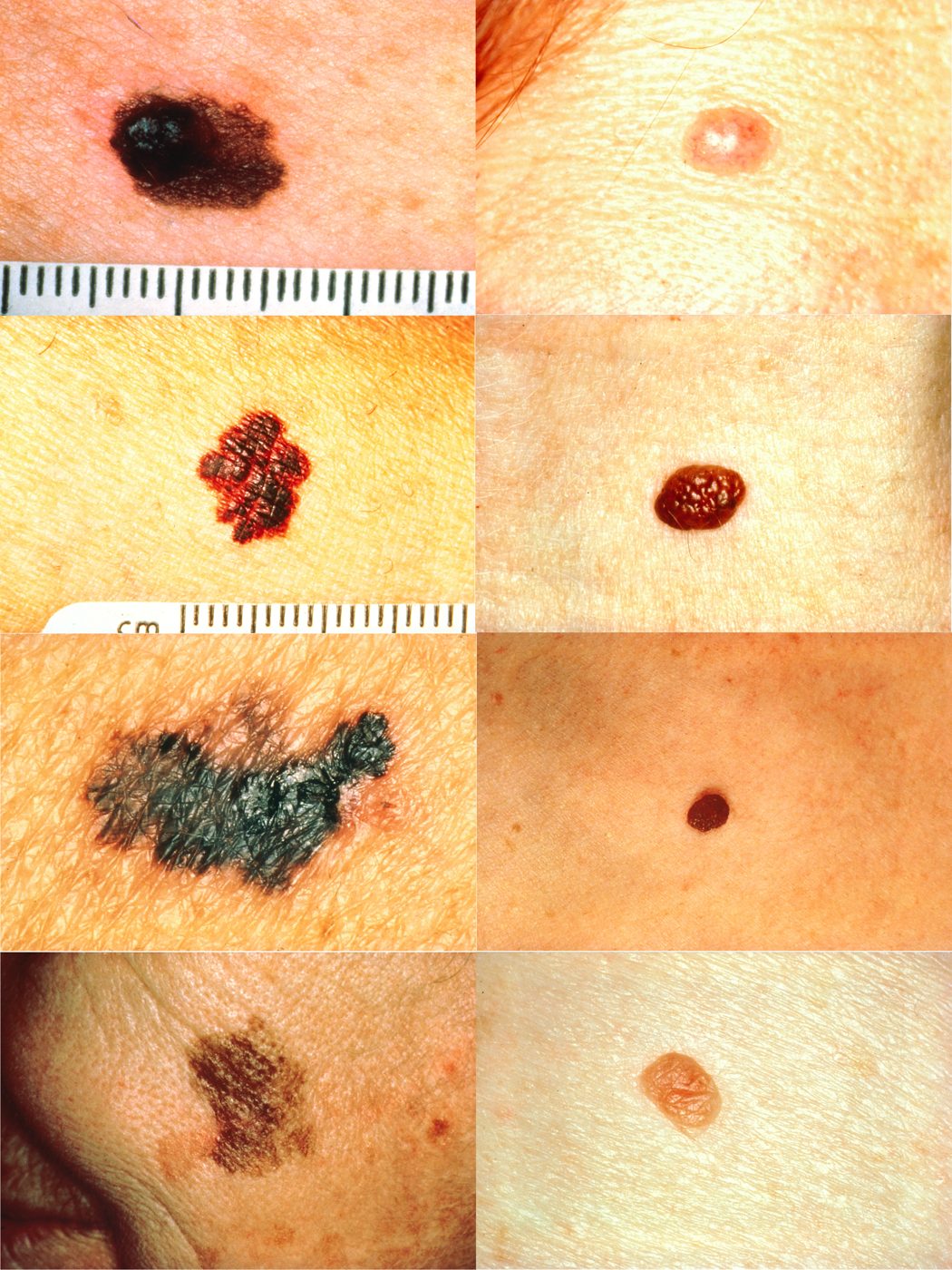 Melanoma compared with a benign mole using the ABCD rule SimpleMed