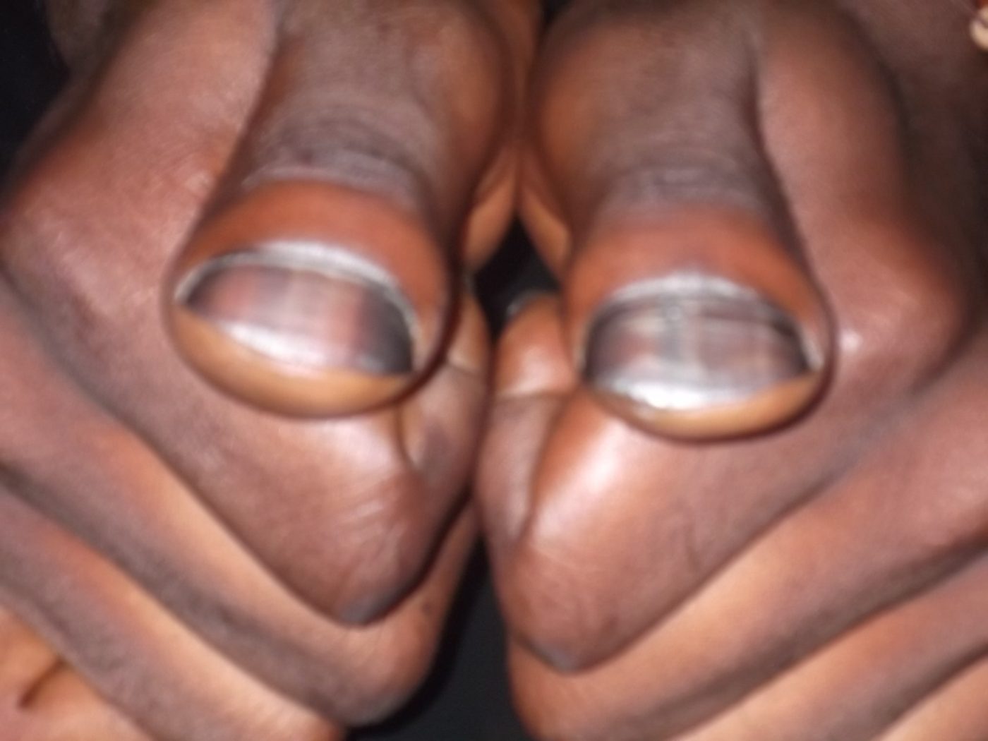 Finger clubbing in respiratory disease