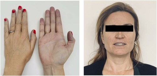 Central cyanosis of the lips and peripheral cyanosis