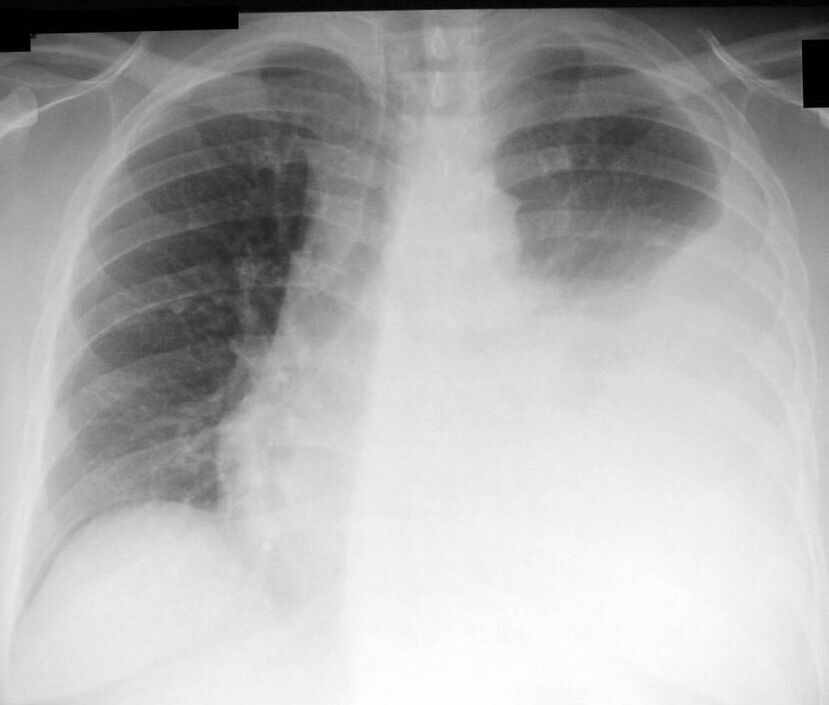 Chest X-ray showing a large left-sided pleural effusion