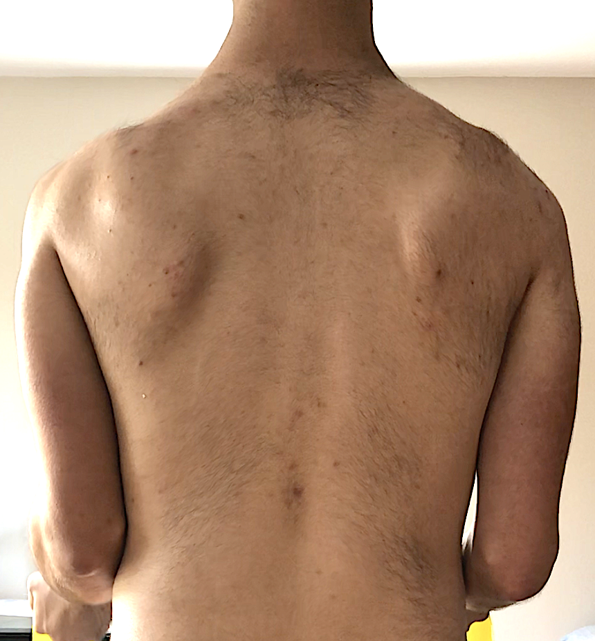 Scapular Winging SimpleMed