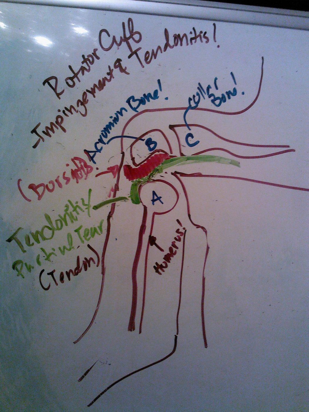 Subacromial Impingement SimpleMed