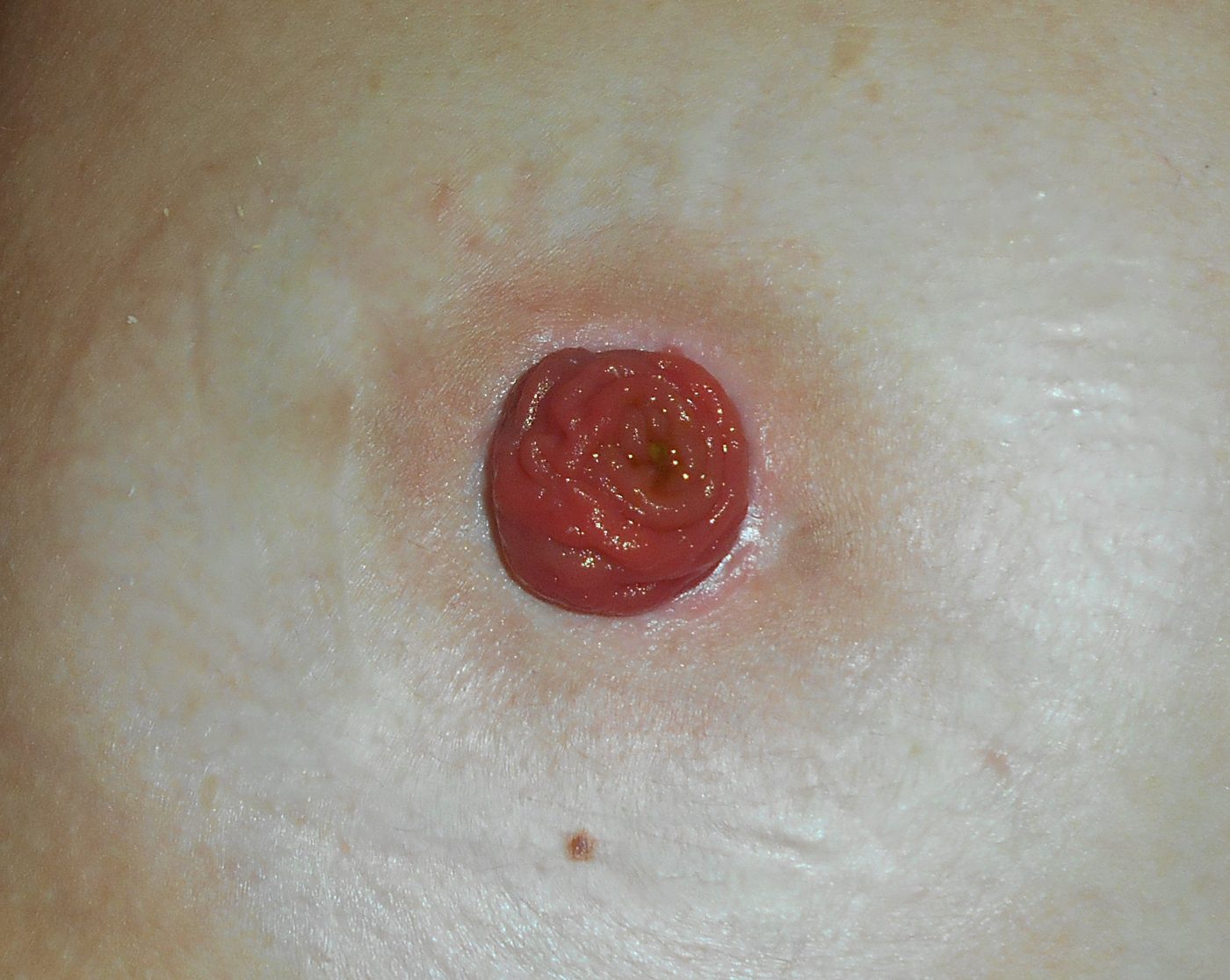 Ileostomy stoma on the abdominal wall SimpleMed