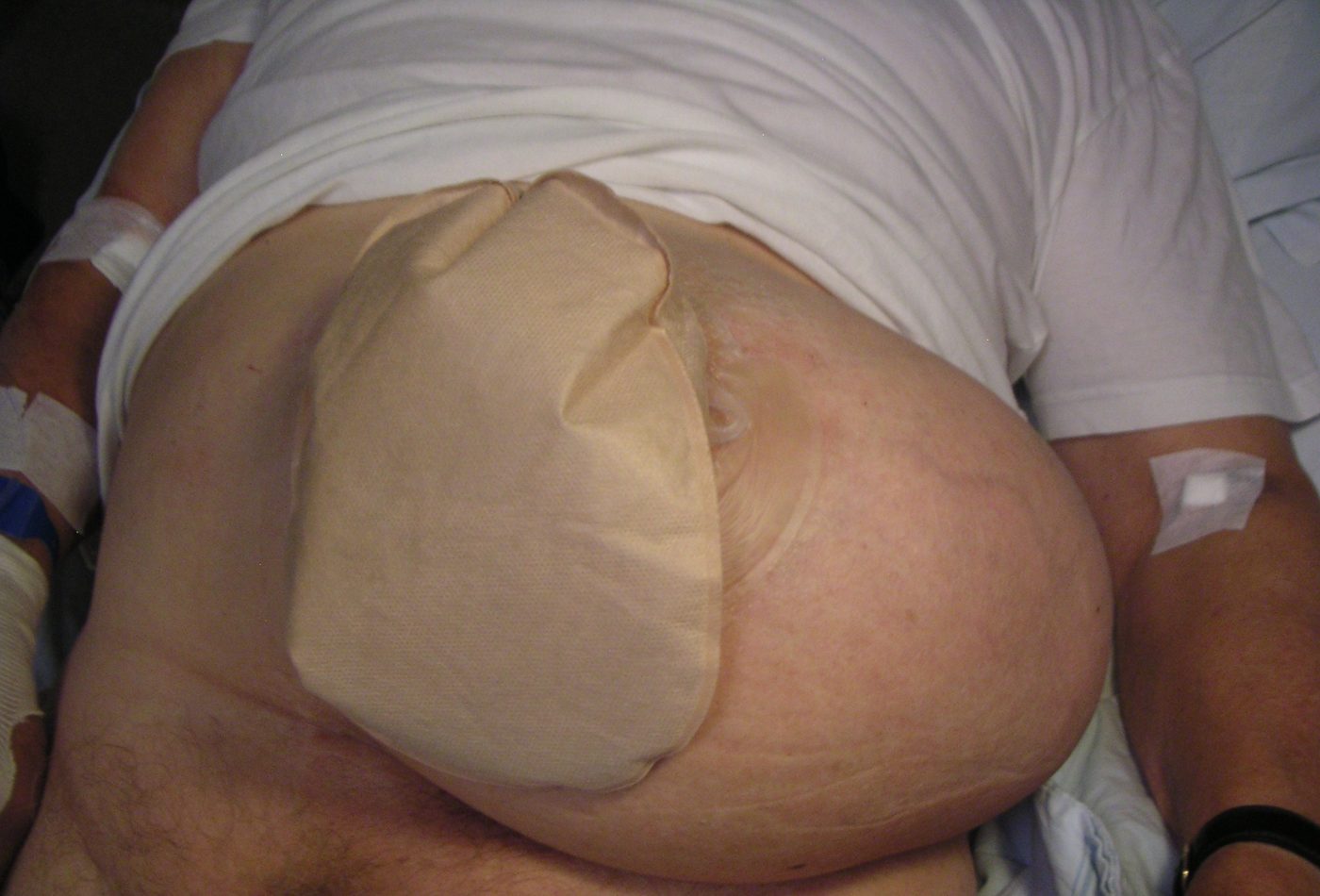 Colostomy with a large parastomal hernia SimpleMed