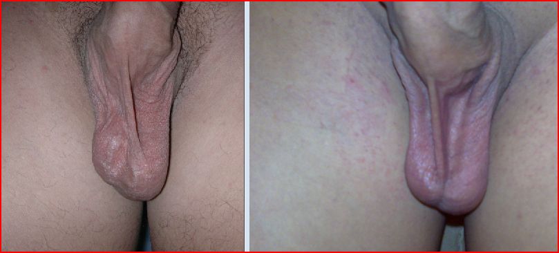 Clinical photograph of a left-sided varicocele SimpleMed