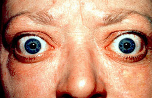Proptosis and Lid Retraction in Graves Disease SimpleMed