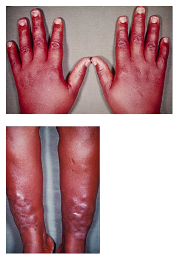 Pretibial Myxoedema and Thyroid Acropachy SimpleMed