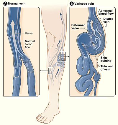 Varicose Veins SimpleMed