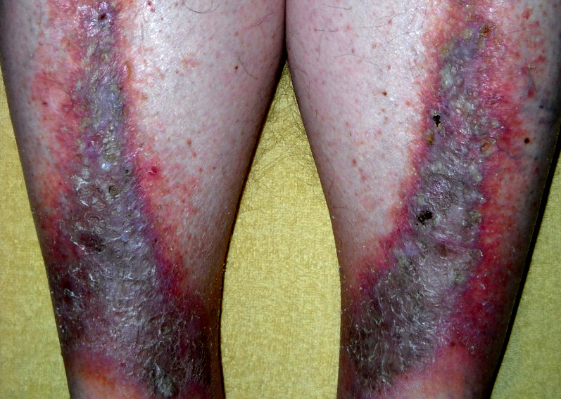 Venous Eczema SimpleMed