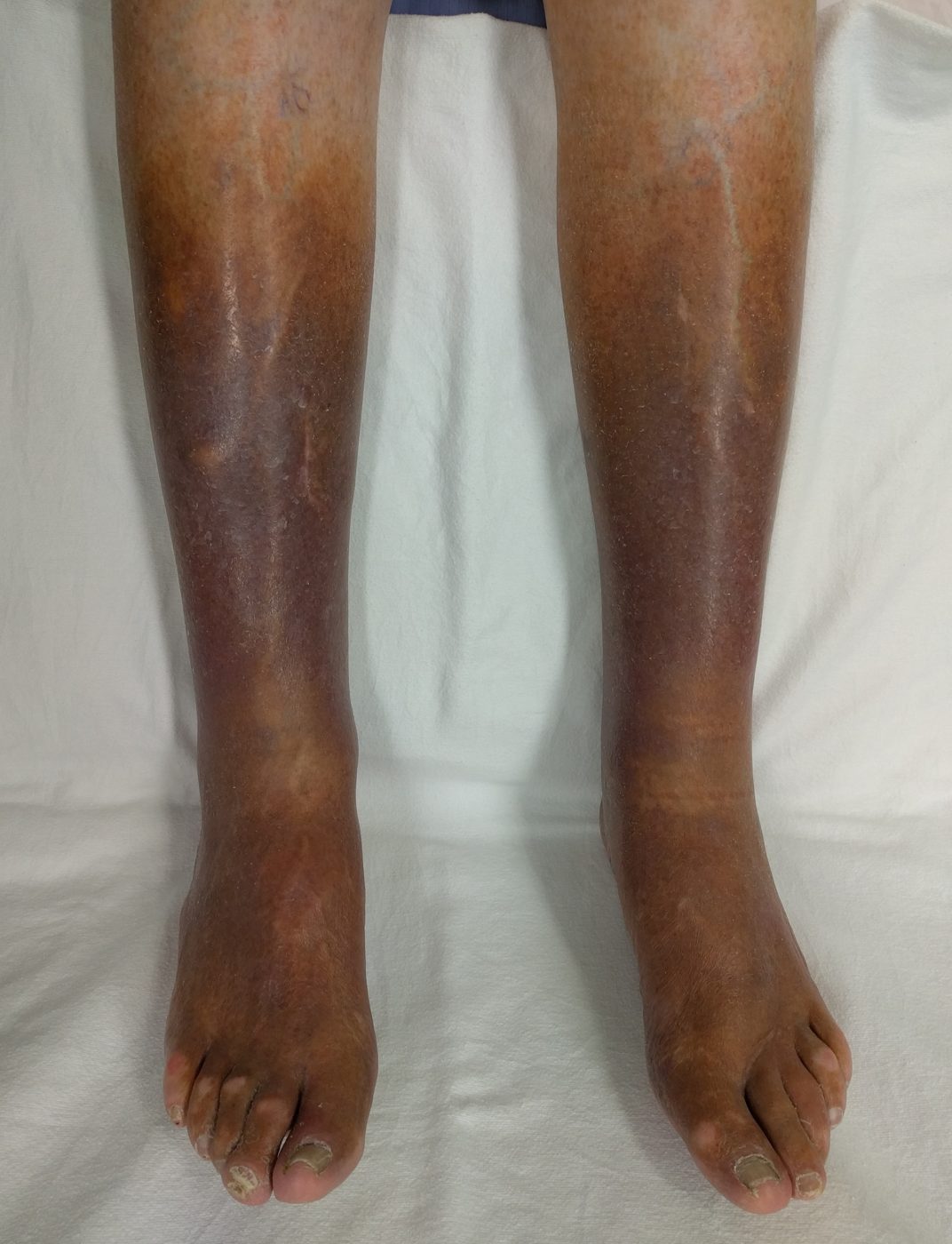 Chronic Venous Insufficiency SimpleMed