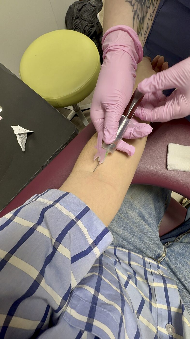 Blood being drawn from a vein in the antecubital fossa SimpleMed