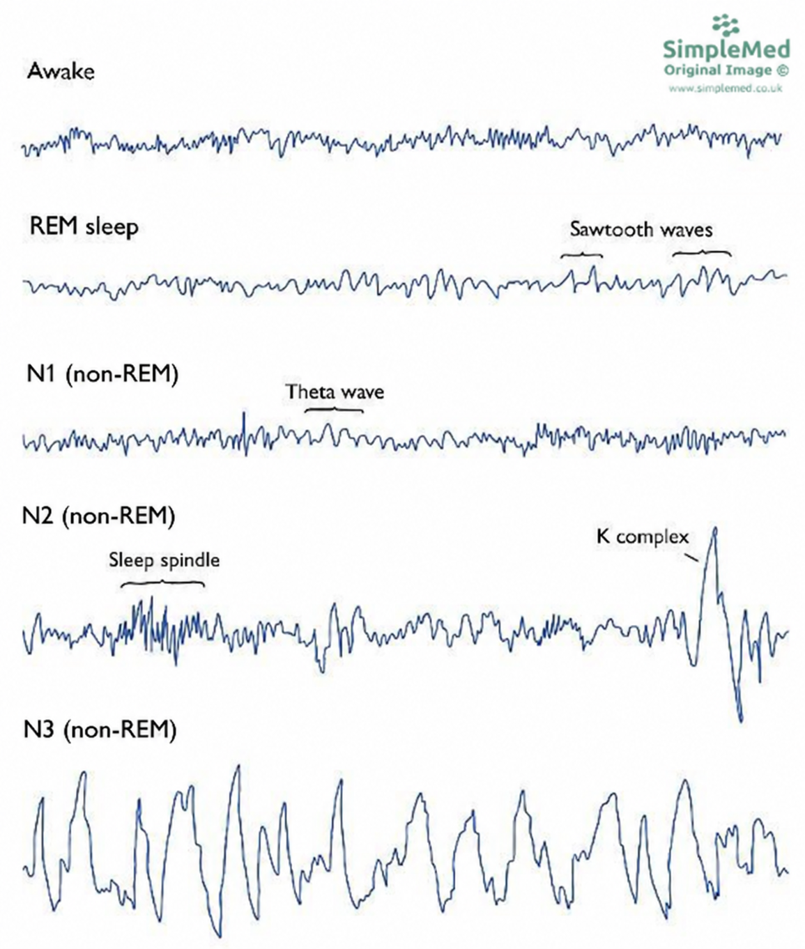 Sleep EEG schematic: N1 theta activity, N2 sleep spindles and K-complexes, N3 slow waves and REM mixed-frequency activity with sawtooth waves.