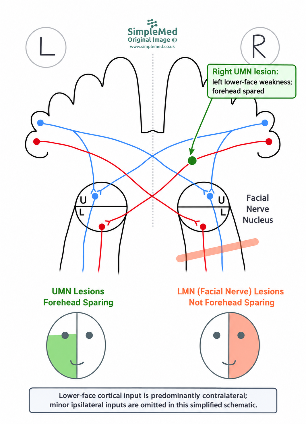 Right supranuclear corticobulbar lesion causes left lower-face weakness with forehead sparing; a separate right peripheral facial nerve lesion weakens the whole right face. Upper-face cortical inputs are bilateral and lower-face inputs predominantly contralateral.