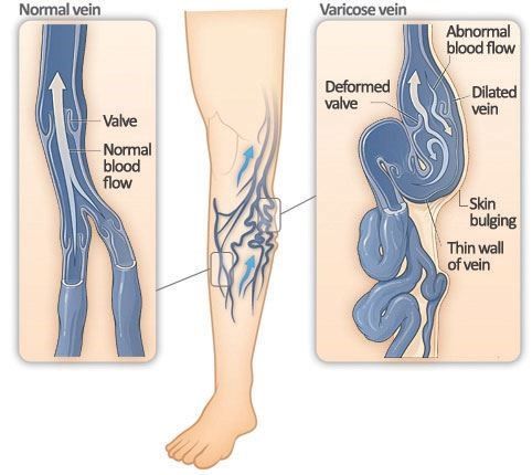 Difference between a normal and varicose vein SimpleMed